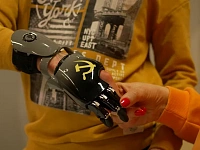 Пострадавшему при взрыве в Красногорске мальчику установили протез руки